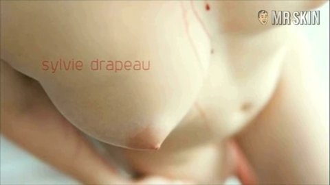3 way nude clips Ileo anal j pouch